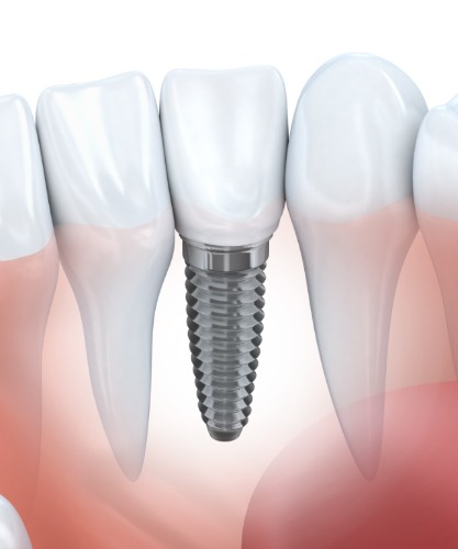 Dental Implants, Surrey Dentist